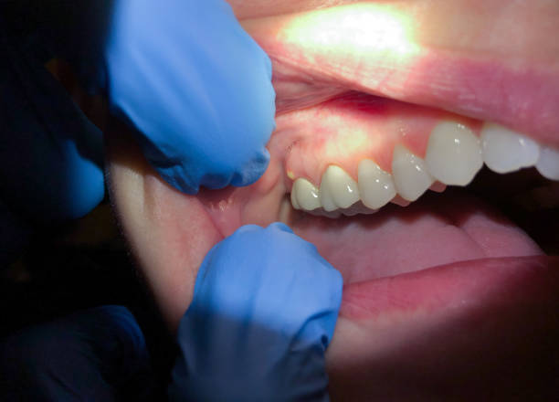 Best Emergency Dental Extractions in Oxford, AL
